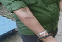 Tangan Kepala Pasar Lakessi, Muh Ramlan, mengalami memar pasca insiden penyerangan saat merelokasi pedagang