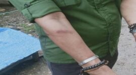 Tangan Kepala Pasar Lakessi, Muh Ramlan, mengalami memar pasca insiden penyerangan saat merelokasi pedagang