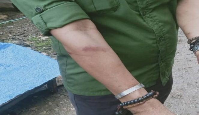 Tangan Kepala Pasar Lakessi, Muh Ramlan, mengalami memar pasca insiden penyerangan saat merelokasi pedagang