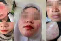 Korban-korban Kosmetik Ilegal