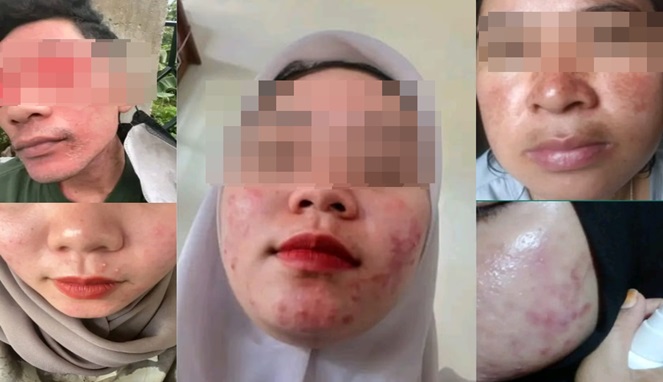 Korban-korban Kosmetik Ilegal