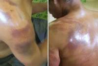 Korban Wendi alami luka lebam usai dianiaya oknum polisi di Polsek Ajangale (Foto Istimewa)