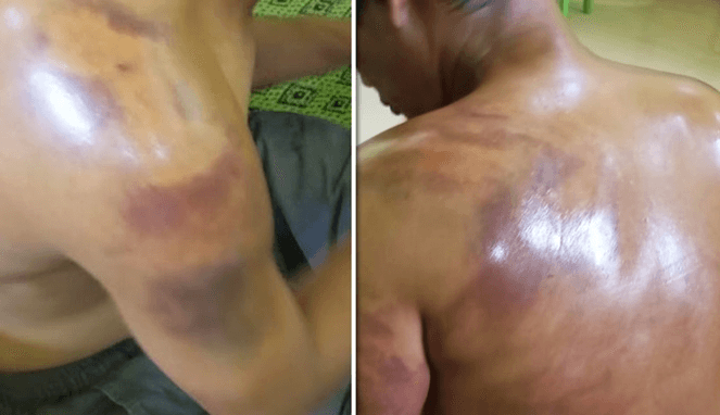 Korban Wendi alami luka lebam usai dianiaya oknum polisi di Polsek Ajangale (Foto Istimewa) 