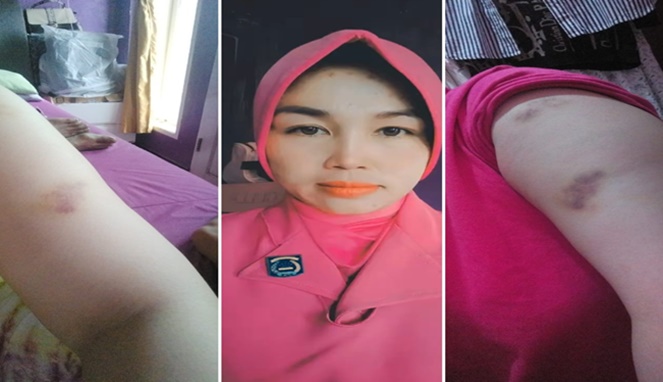 Foto Kolase : Ernawati, Istri Seorang Polisi Dianiaya oleh Pemilik Klinik Dr. Cece