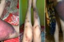 Tangkapan layar kondisi kaki korban Selvy yang mengalami lebam serius diduga akibat penganiayaan suaminya. (Foto kolase)