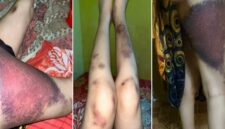 Tangkapan layar kondisi kaki korban Selvy yang mengalami lebam serius diduga akibat penganiayaan suaminya. (Foto kolase)