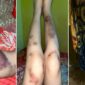 Tangkapan layar kondisi kaki korban Selvy yang mengalami lebam serius diduga akibat penganiayaan suaminya. (Foto kolase)