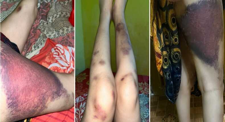 Tangkapan layar kondisi kaki korban Selvy yang mengalami lebam serius diduga akibat penganiayaan suaminya. (Foto kolase)