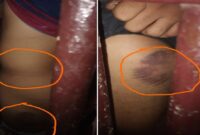 Bekas luka memar pada tubuh korban yang diduga akibat penganiayaan oleh empat oknum polisi di Polsek Mangarabombang, Kabupaten Takalar. Lingkaran oranye menyoroti area luka yang jelas terlihat di lengan dan kaki korban, memperkuat dugaan kekerasan fisik yang dilaporkan ke Propam Polres Takalar. (Foto kolase)