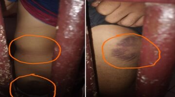 Bekas luka memar pada tubuh korban yang diduga akibat penganiayaan oleh empat oknum polisi di Polsek Mangarabombang, Kabupaten Takalar. Lingkaran oranye menyoroti area luka yang jelas terlihat di lengan dan kaki korban, memperkuat dugaan kekerasan fisik yang dilaporkan ke Propam Polres Takalar. (Foto kolase)