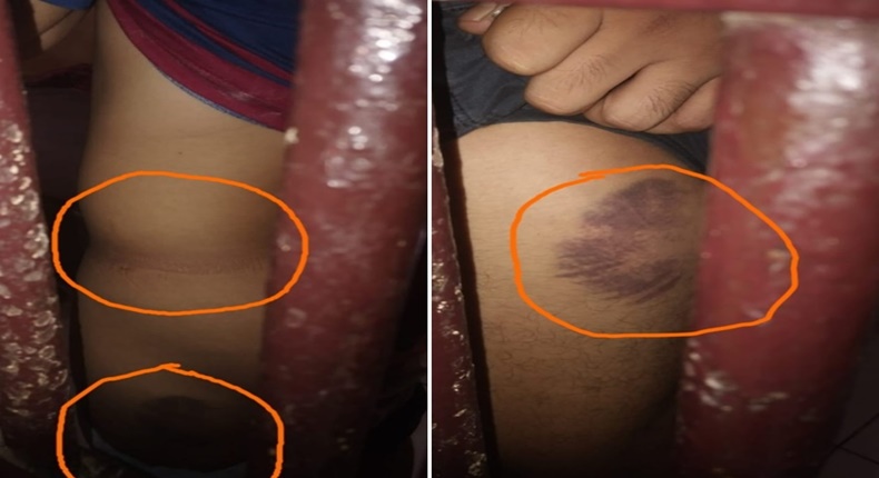 Bekas luka memar pada tubuh korban yang diduga akibat penganiayaan oleh empat oknum polisi di Polsek Mangarabombang, Kabupaten Takalar. Lingkaran oranye menyoroti area luka yang jelas terlihat di lengan dan kaki korban, memperkuat dugaan kekerasan fisik yang dilaporkan ke Propam Polres Takalar. (Foto kolase)