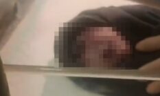 Lahir dengan Kelainan Langka, Bayi Bermata Satu di Kendari Cuma Hidup 5 Jam