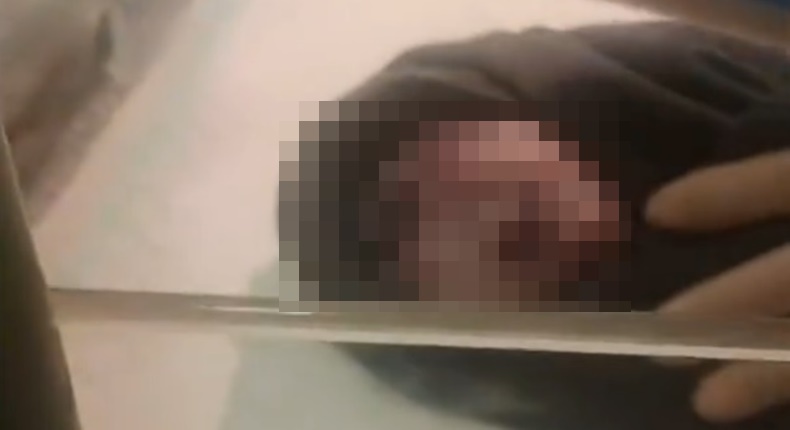 Tangkapan layar video viral yang memperlihatkan kondisi bayi bermata satu saat dilahirkan di RSUD Kota Kendari, Sulawesi Tenggara.