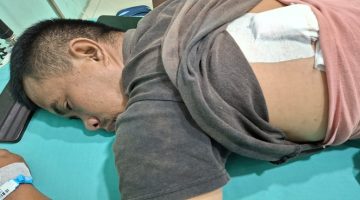 Kondisi Rahmat Saputra (36), pedagang korban pembacokan di Percut Sei Tuan, saat menjalani perawatan medis dengan perban penutup luka jahitan di punggungnya.